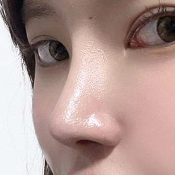 nose case 03 point 04