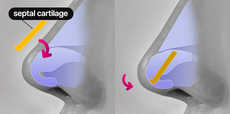 nose case 04 method 01