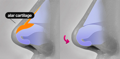 nose case 04 method 02