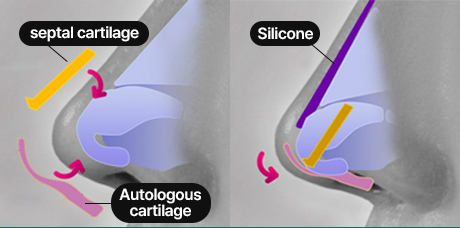 nose case 04 method 03