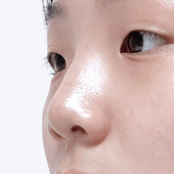 nose case 04 point 01