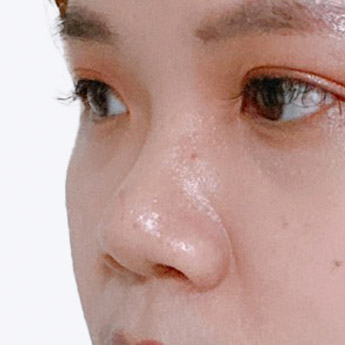 nose case 04 point 03