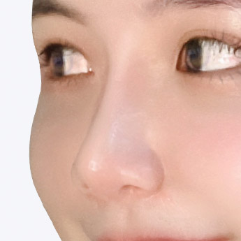 nose case 04 point 04