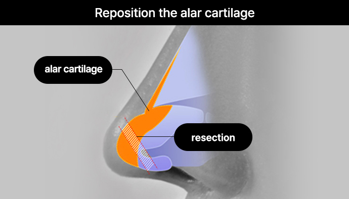 nose case 05 method 01