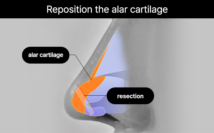 nose case 05 method 01 mo