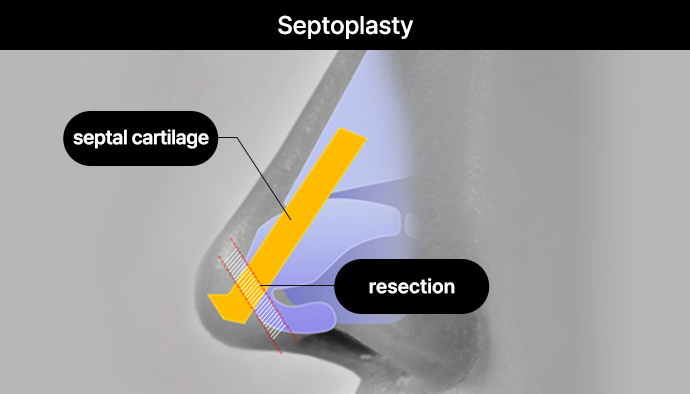 nose case 05 method 02