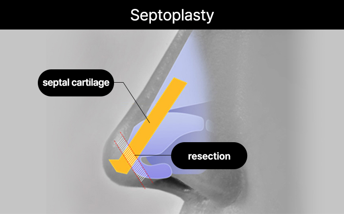 nose case 05 method 02 mo