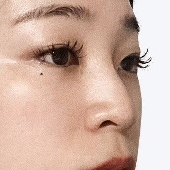 nose case 05 point 01