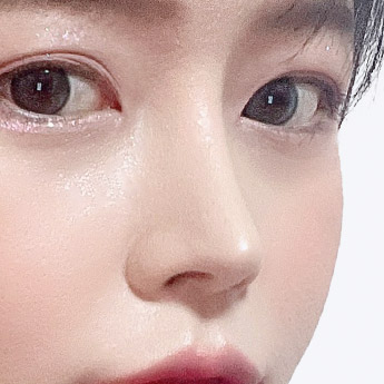 nose case 05 point 04