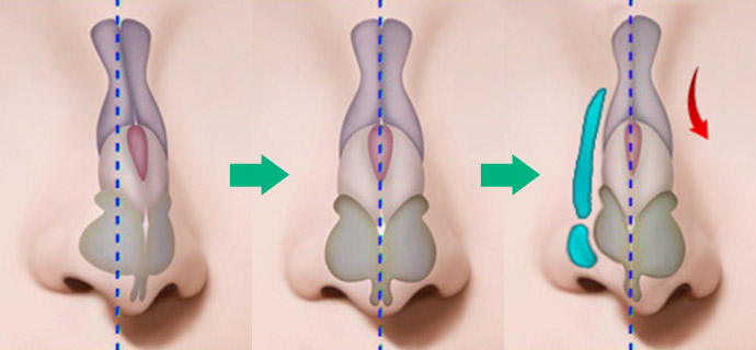 nose case 06 method 01
