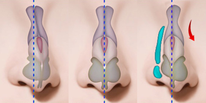 nose case 06 method 01 mo