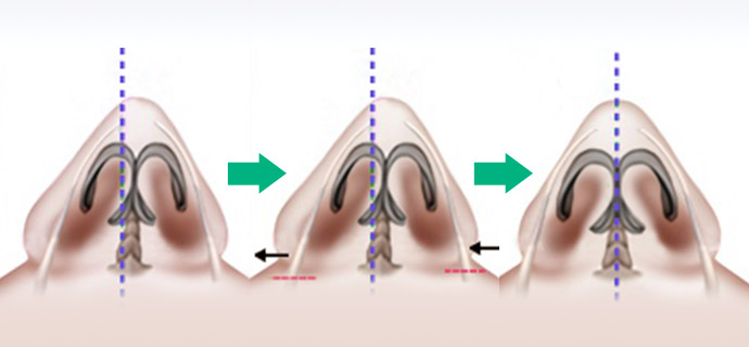 nose case 06 method 02