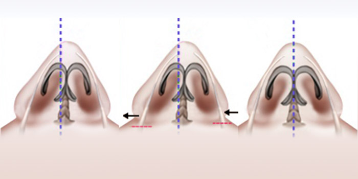 nose case 06 method 02 mo