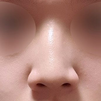 nose case 06 point 03