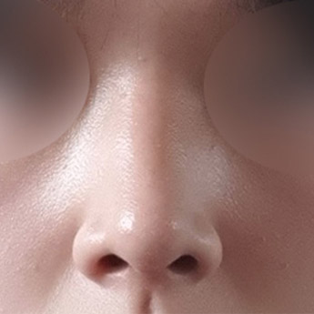 nose case 06 point 04