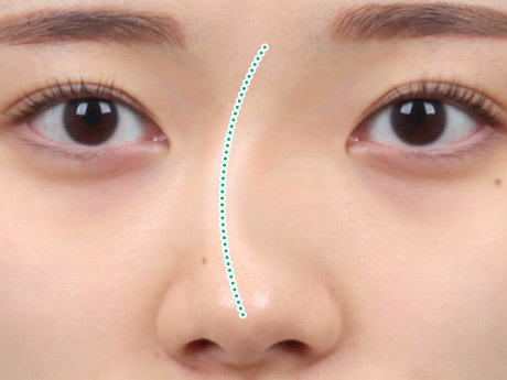 nose case 06 type1 01