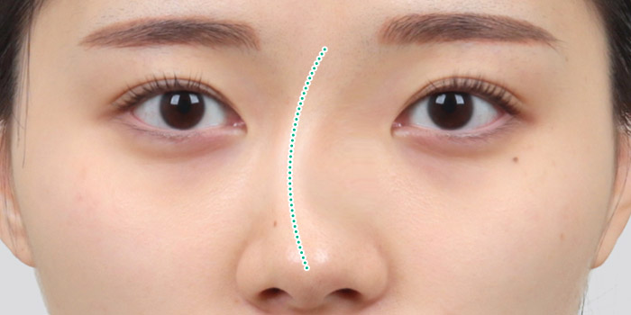 nose case 06 type1 01 mo