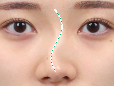 nose case 06 type1 02