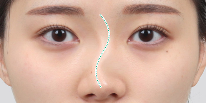 nose case 06 type1 02 mo