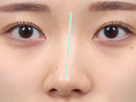 nose case 06 type1 03