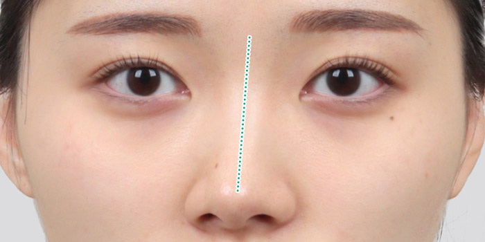 nose case 06 type1 03 mo