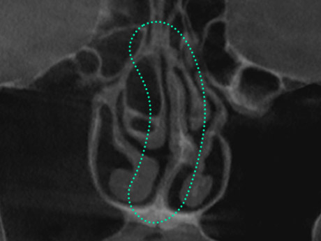 nose case 06 type2 01