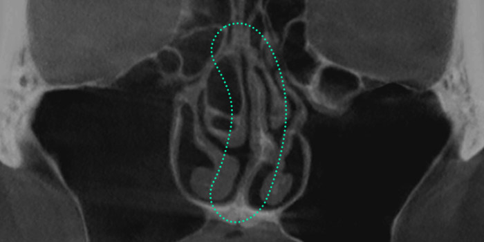 nose case 06 type2 01 mo