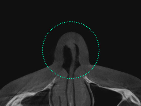 nose case 06 type2 02