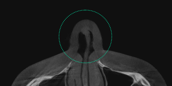 nose case 06 type2 02 mo