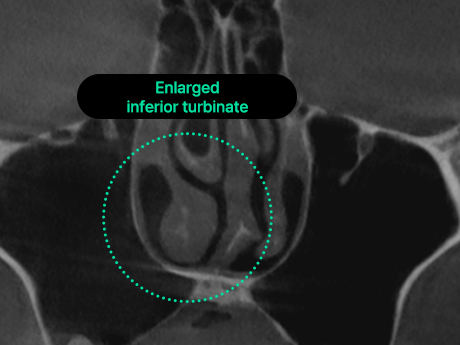 nose case 06 type2 03