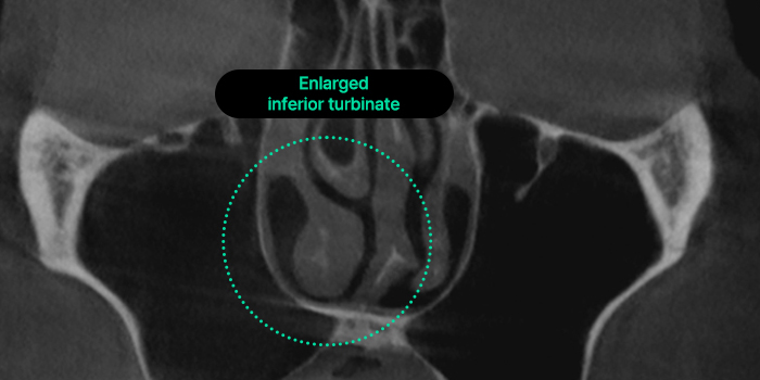 nose case 06 type2 03 mo