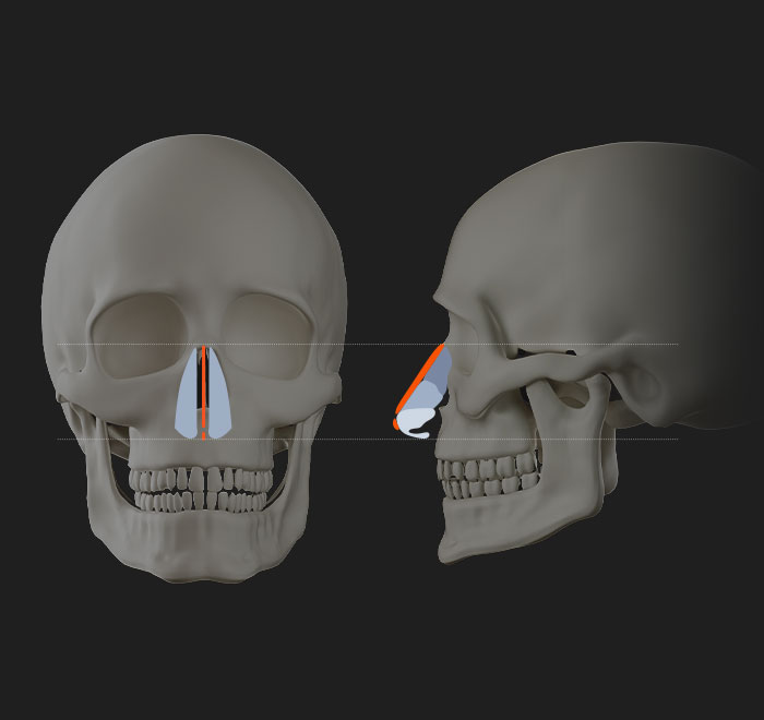 nose implants slider 01 mo