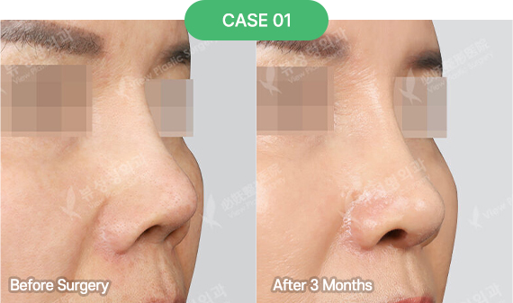 nose reoperation bytype 1 1 pc