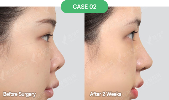 nose reoperation bytype 1 2 pc