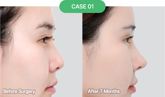 nose reoperation bytype 2 1 pc