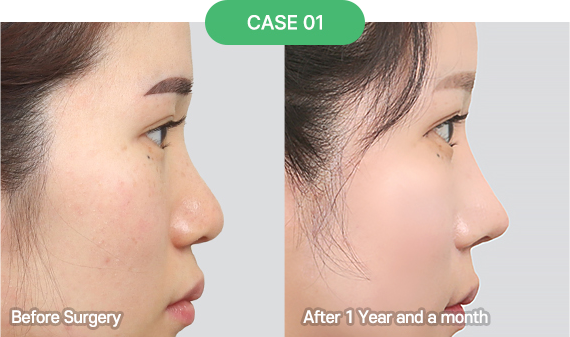 nose reoperation bytype 3 1 pc