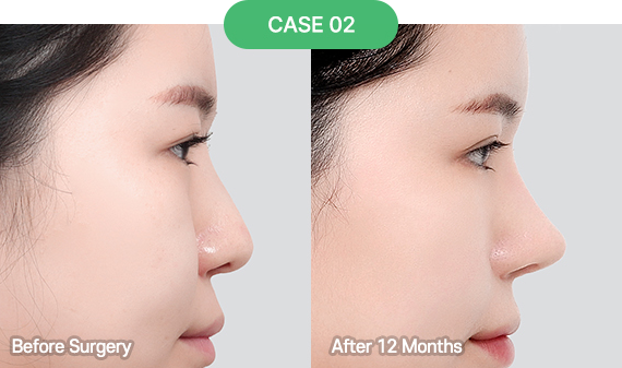 nose reoperation bytype 3 2 pc