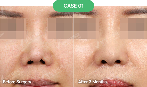 nose reoperation bytype 4 1 pc