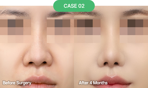 nose reoperation bytype 4 2 pc