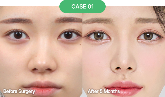 nose reoperation bytype 5 1 pc