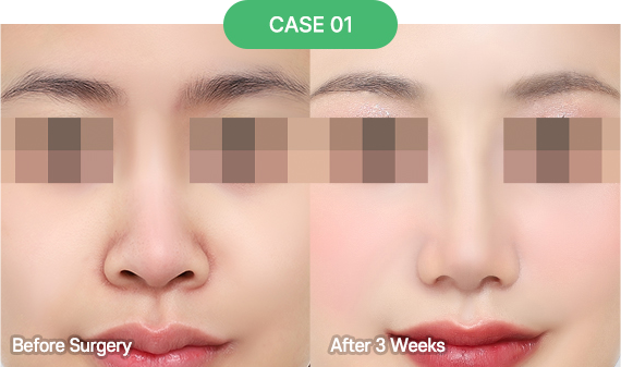 nose reoperation bytype 6 1 pc