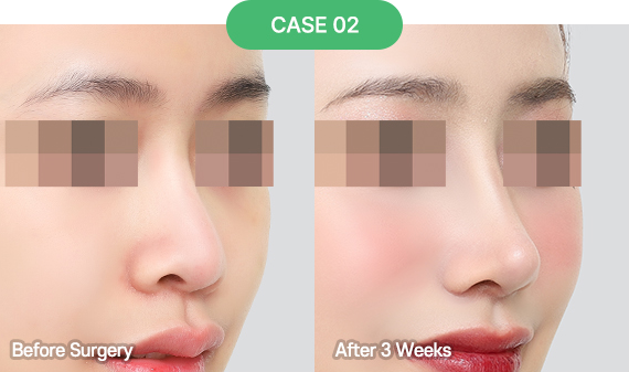 nose reoperation bytype 6 2 pc