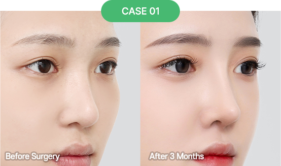 nose reoperation bytype 7 1 pc