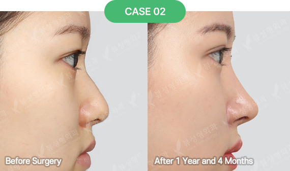 nose reoperation bytype 7 2 pc