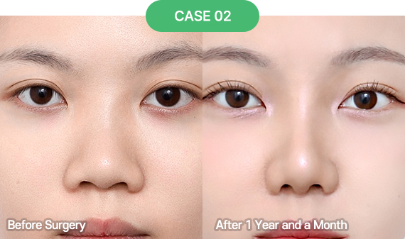 nose reoperation case 2 2 pc