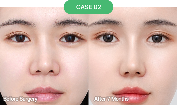 nose reoperation case 5 2 pc