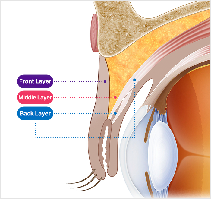 reoperation slide 2 mo