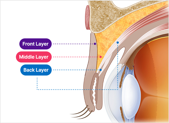 reoperation slide 2 pc