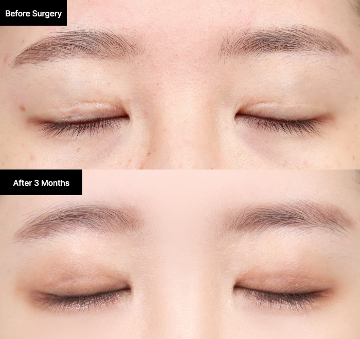 reoperation slide 3 mo