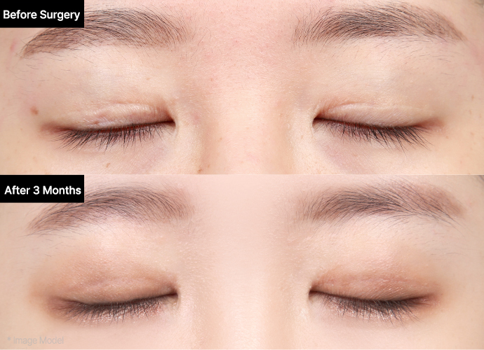 reoperation slide 3 pc